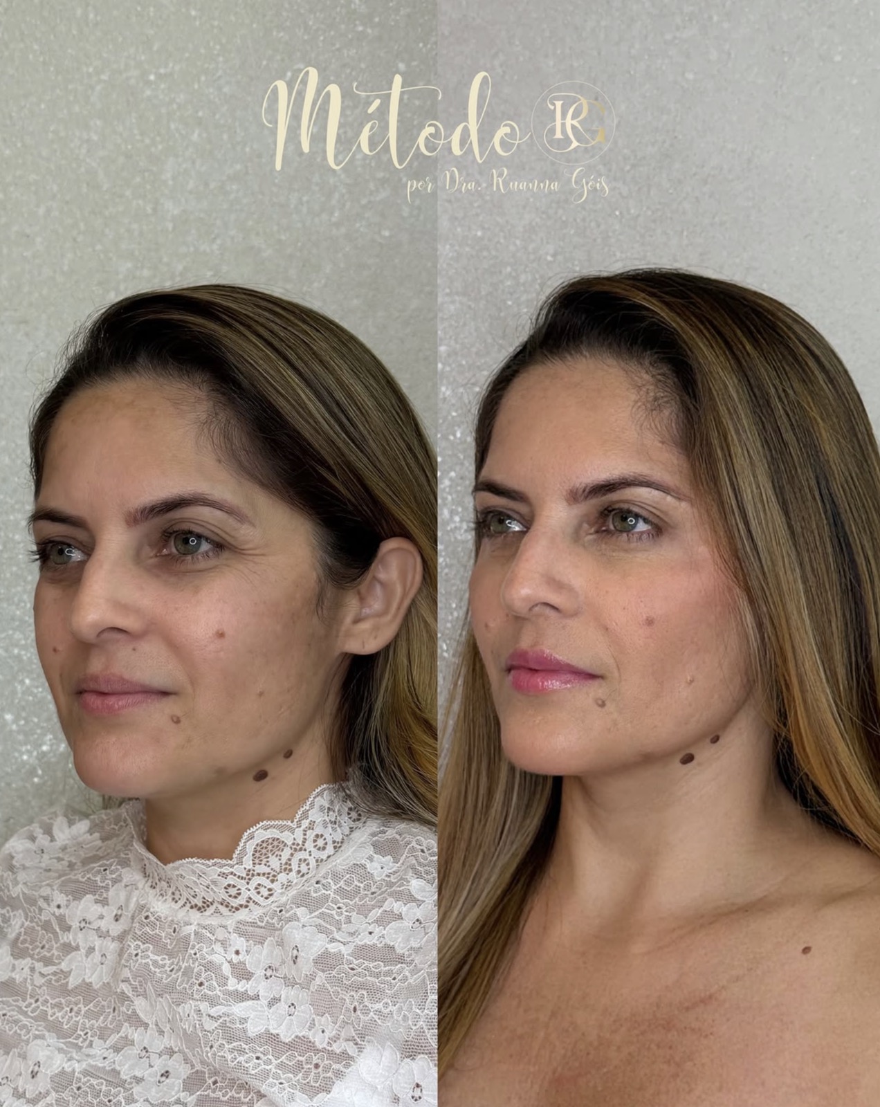 Imagem ilustrativa — Harmonização Facial com o Método RG